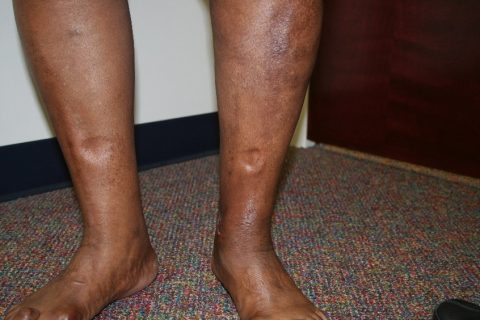 Leg Swelling or Medical Term Edema - Vein Specialists of the Carolinas