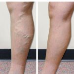 Non-Surgical Vein Treatment Options