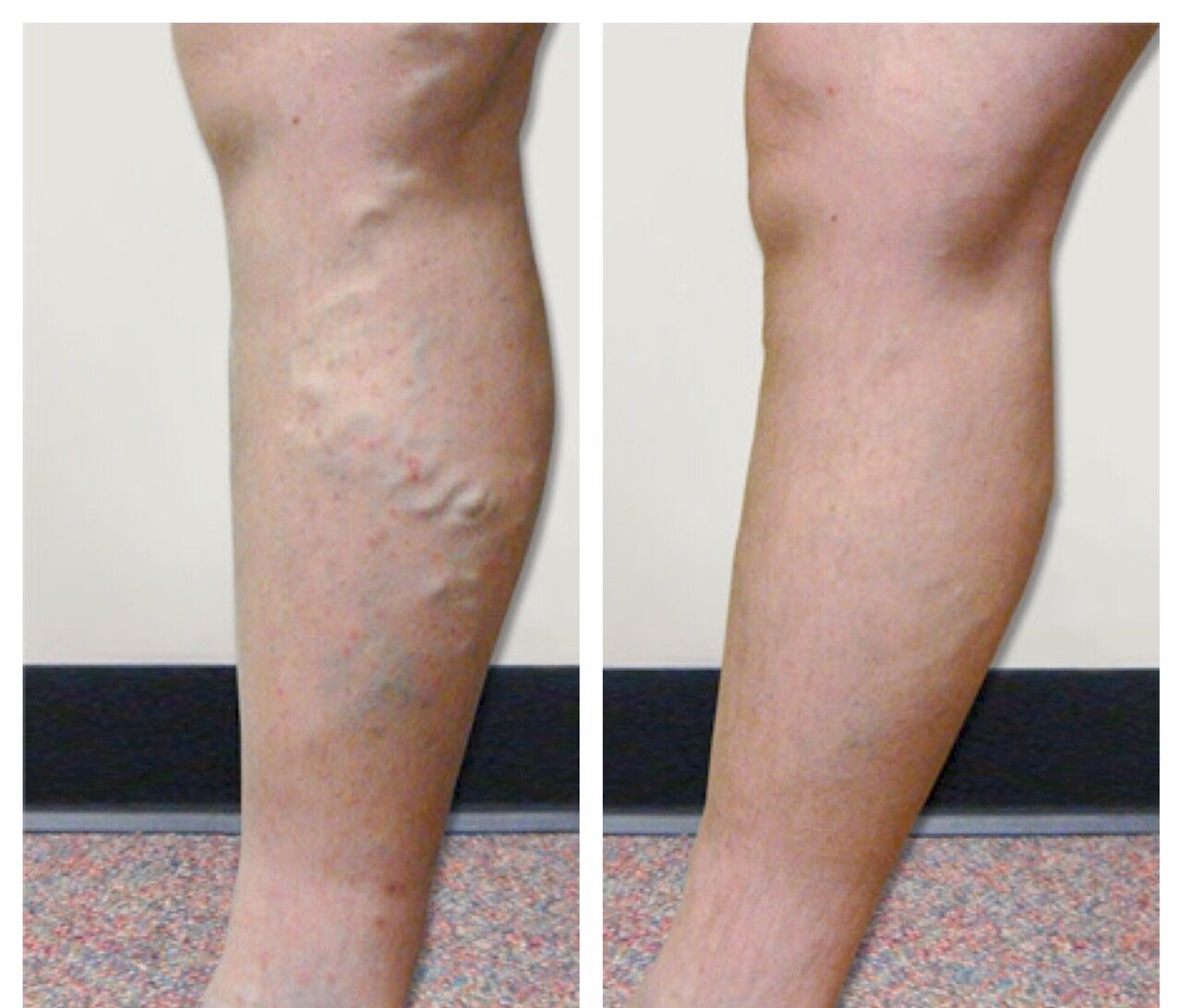 Before & After Photos - Vein Specialists of the Carolinas