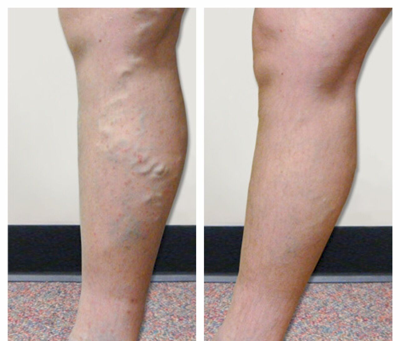 Varicose Veins Vein Specialists Of The Carolinas