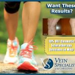 Cosmetic Sclerotherapy Discount...Spider Veins No More!
