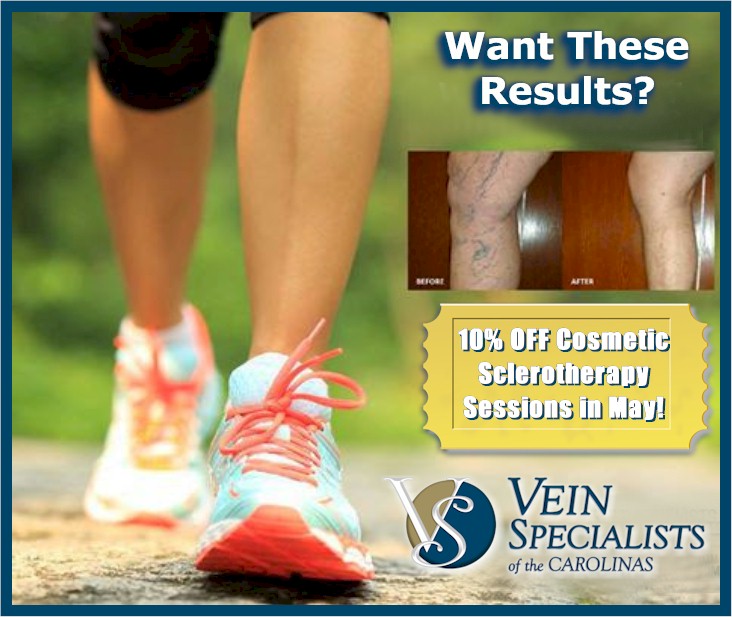 Cosmetic Sclerotherapy Discount…Spider Veins No More!