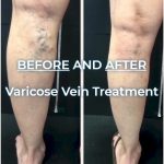 You Know What Day It Is – Today Is Transformation Tuesday!, Vein Specialists of the Carolinas before and after varicose vein treatment