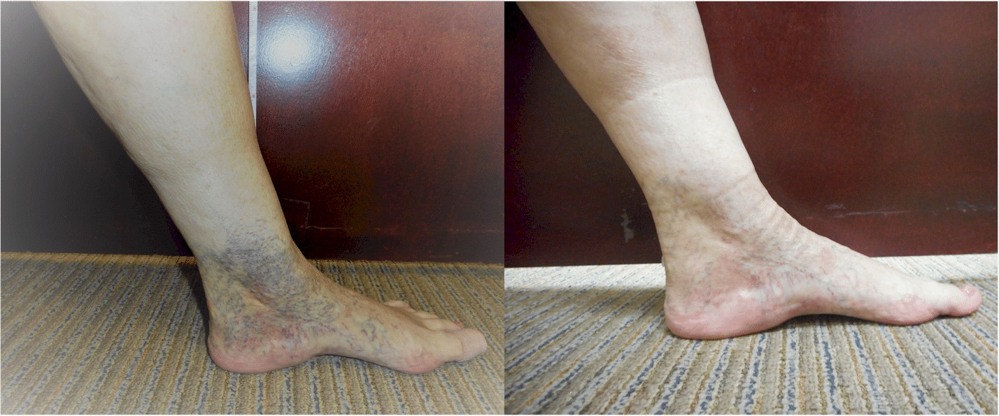 spider-veins-before-and-after-ankle sclerotherapy