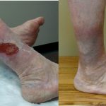 Today is Transformation Tuesday!, Vein Specialists of the Carolinas Venous Insufficiency - The Most Common Cause Of Lower-Leg Ulcers