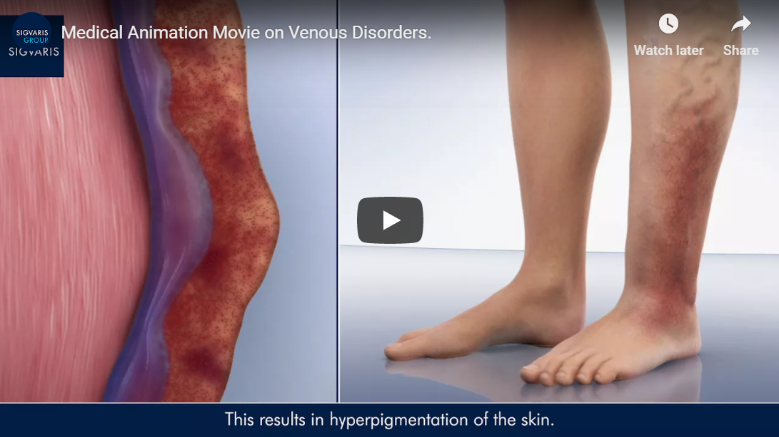 The Beneficial Effects Of Wearing SIGVARIS Compression Stockings. - Vein  Specialists of the Carolinas
