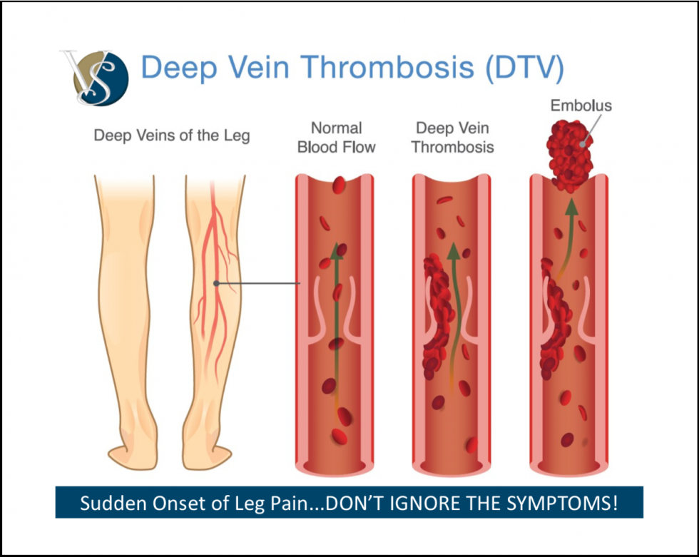 symptoms of deep vein thrombosis in leg