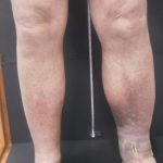 What is May-Thurner Syndrome?