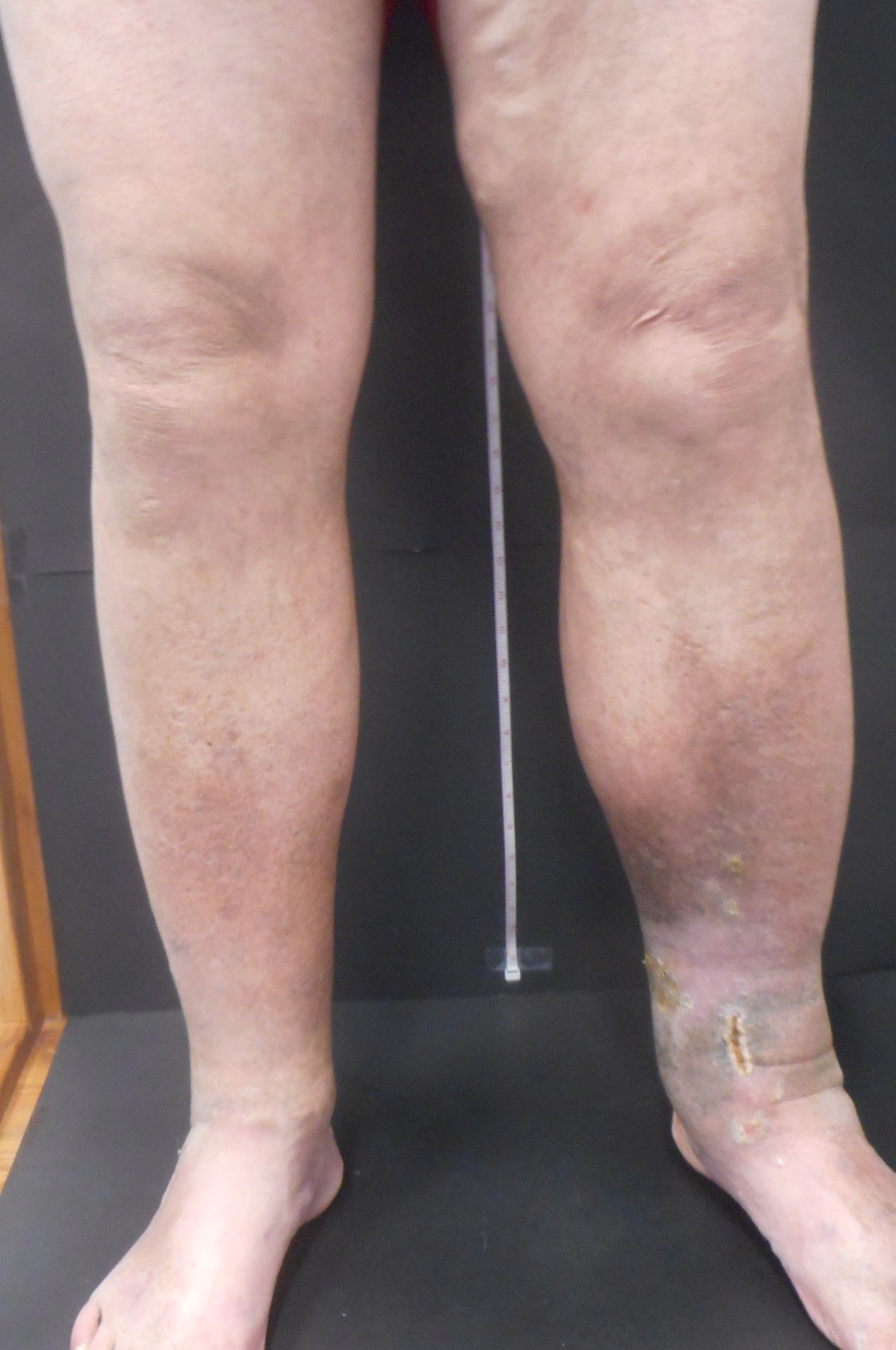 Do You Have Unexplained Swelling In Your Left Leg? What Does It Mean? -  Vein Specialists of the Carolinas