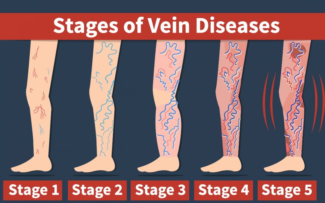 Venous Disease Millions Suffer But Treatments Can Be Life Changing 