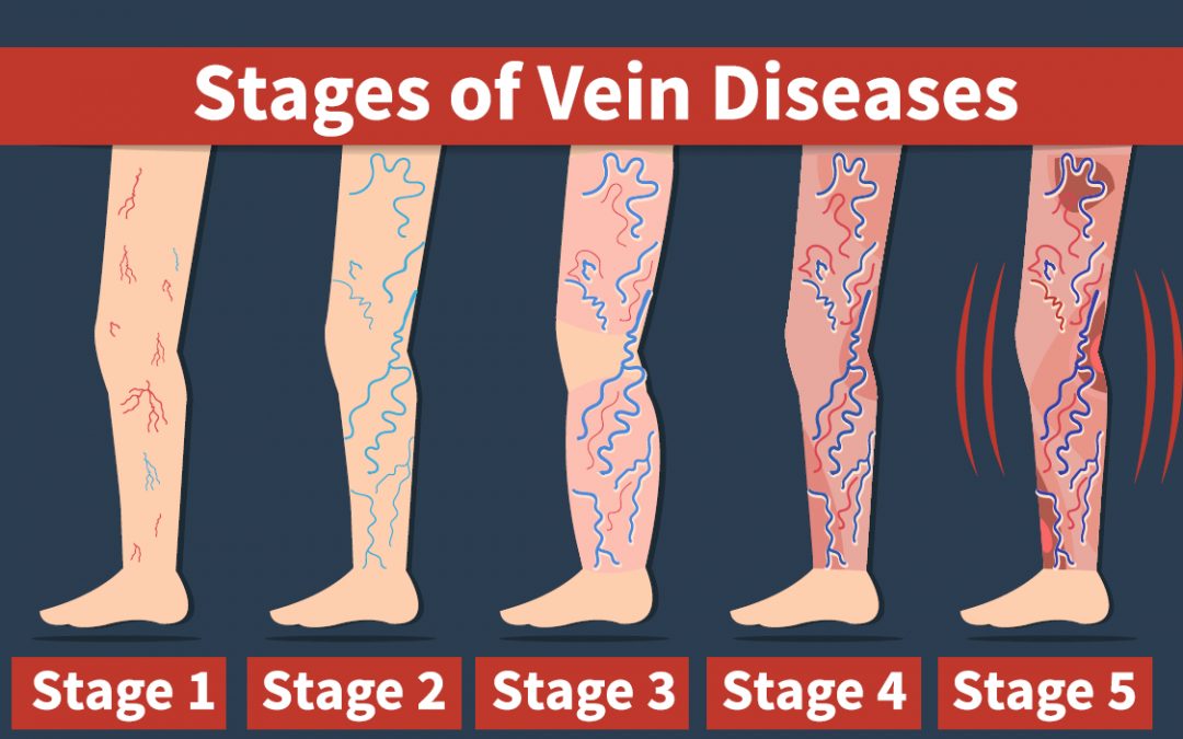 Venous Disease Millions Suffer But Treatments Can Be Life Changing