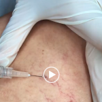 Sclerotherapy for Spider Veins Demonstration