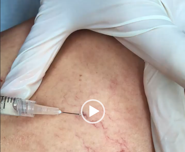 Sclerotherapy for Spider Veins Demonstration