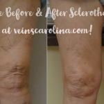 10% Off Sclerotherapy for the Entire Month of September!