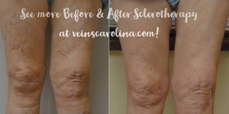 10% Off Sclerotherapy for the Entire Month of September!