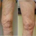 Valentines Special On Cosmetic Sclerotherapy – Vein Specialists Of The Carolinas, Vein Specialists of the Carolinas 10% Off Cosmetic Sclerotherapy for Spider Veins - Call for An Appointment!