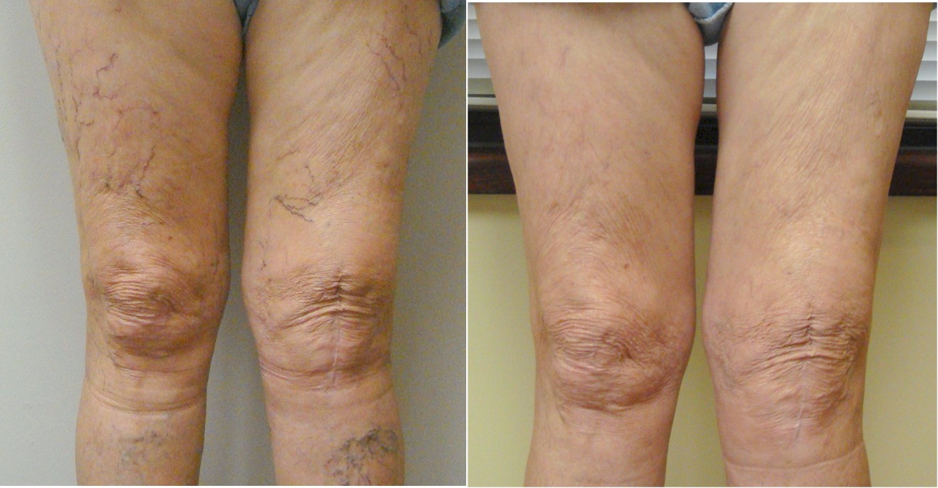 10% Off Cosmetic Sclerotherapy for Spider Veins – Call for An Appointment!