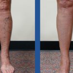 VSC is offering 10% off all Cosmetic Spider Vein Treatments during the month of June!, Vein Specialists of the Carolinas Last Day To Schedule 10% Off Cosmetic Sclerotherapy In September!