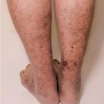 What Is Post Thrombotic Syndrome (PTS)?