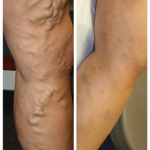 FREQUENTLY ASKED QUESTION: What Is Superficial Venous Reflux?