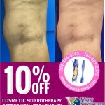 Say Goodbye To Spider Veins Before Spring!