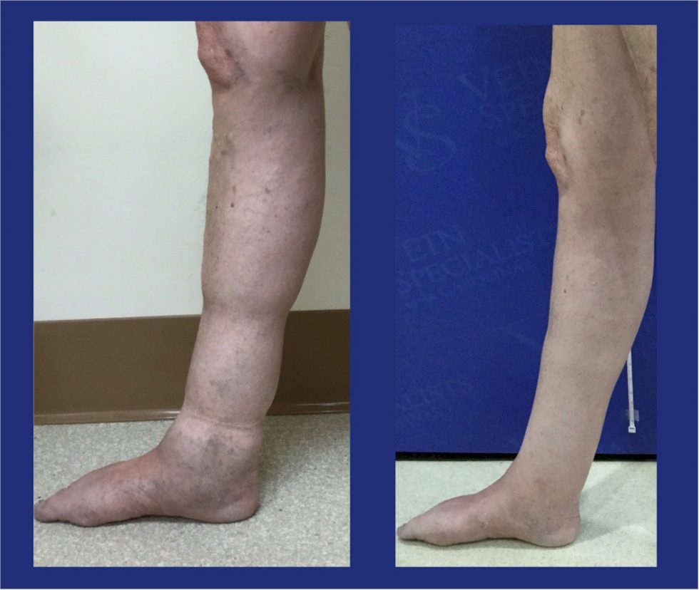 Before and After Treatment Sample - Vein Specialists of the Carolinas