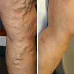 Leg Pain - Before and After Varicose Veins Treatment