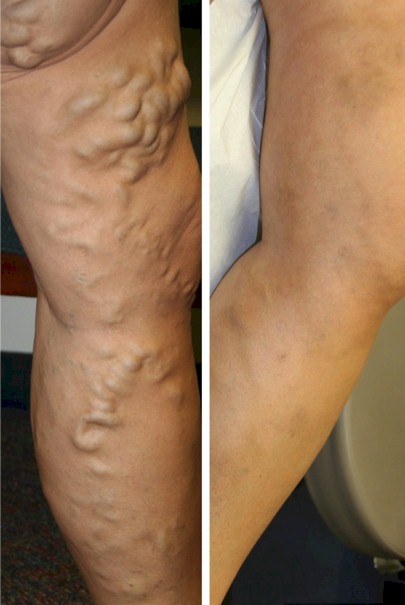 Leg Pain - Before and After Varicose Veins Treatment
