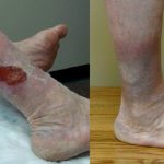 Why are Compression Garments Necessary To Treat Varicose Veins?, Vein Specialists of the Carolinas leg ulcers