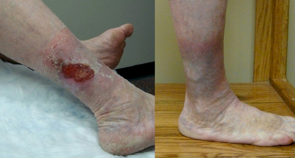 Am I at Risk for Leg Ulcers?