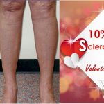 LOVE YOUR LEGS With Sclerotherapy Treatments!