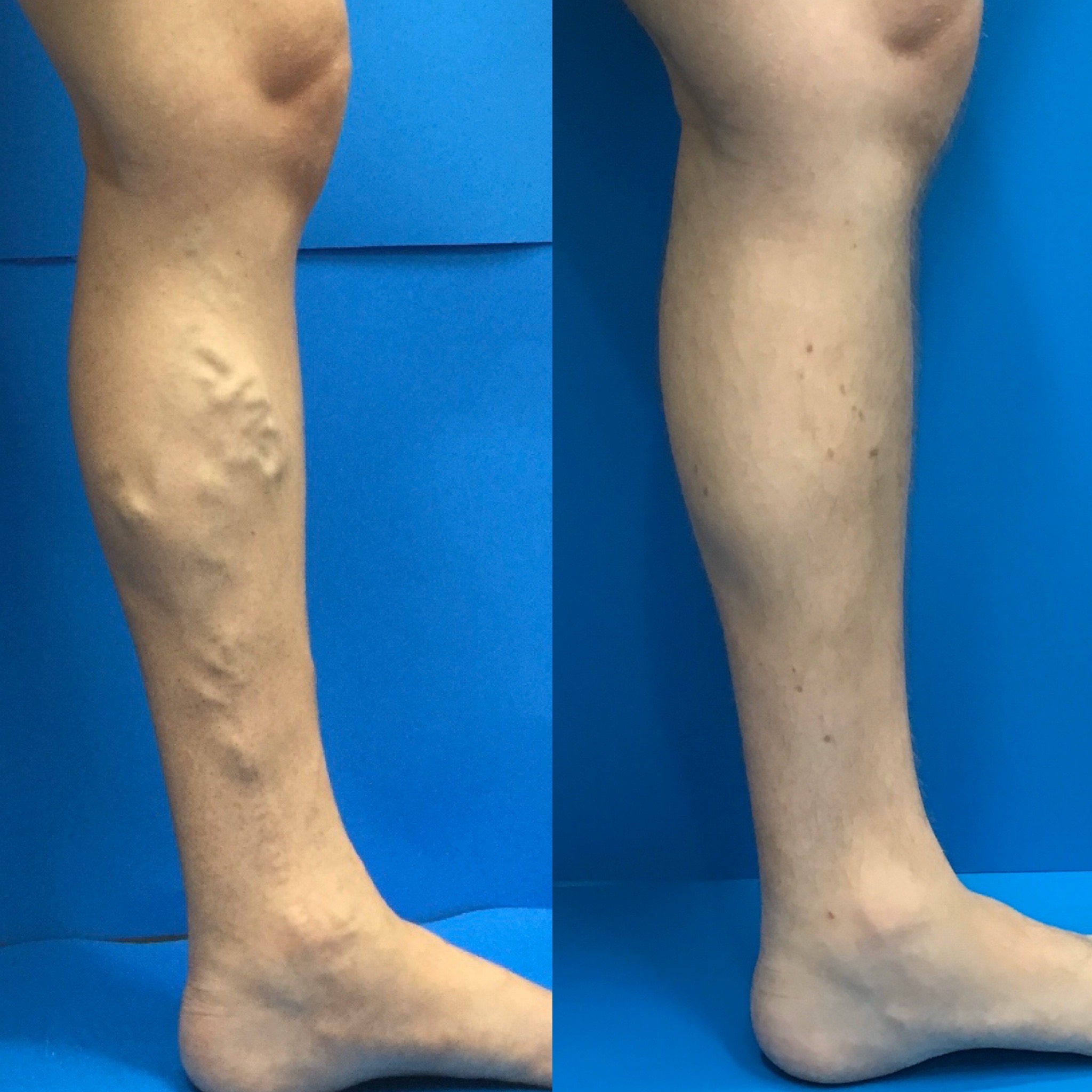 Do You Know How to Recognize Varicose Veins?