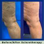 what is sclerotherapy