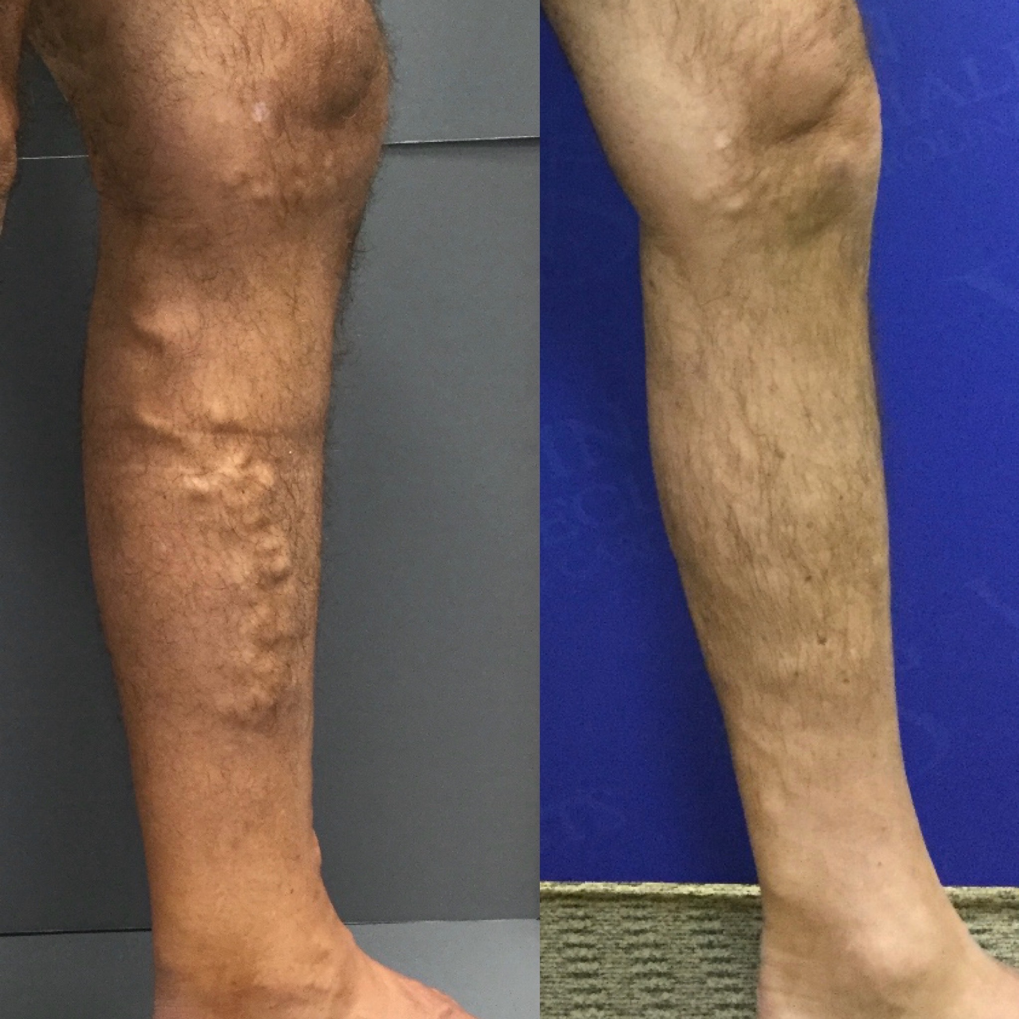 Before and After- Varicose Veins 2