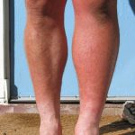 DVT Deep Vein Thrombosis image