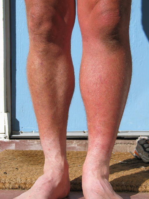 Do You Have Swelling and Pain in Your Legs? It May Be Deep Vein Thrombosis.