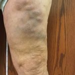What is Phlebitis?