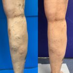 Do Spider Veins Hurt?