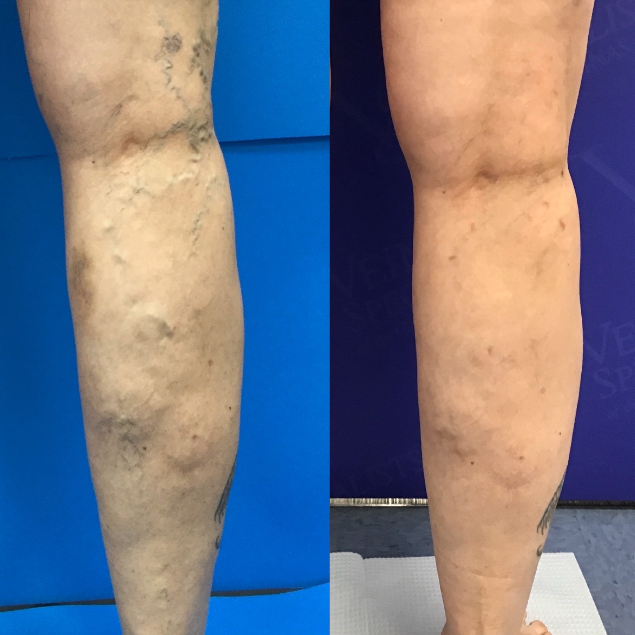 Spider Veins Are A Sign Of A Deeper Vascular Disease