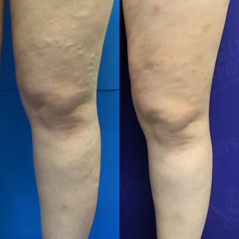 Before And After Vein Treatment Photos Vein Specialists Of The Carolinas