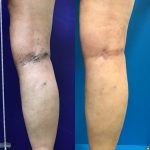 🎃🕷️✨ FREAKY FRIDAY ✨🦇🎃 Are Your Veins Scary?, Vein Specialists of the Carolinas Fall Vein Treatment Is the Perfect Time!