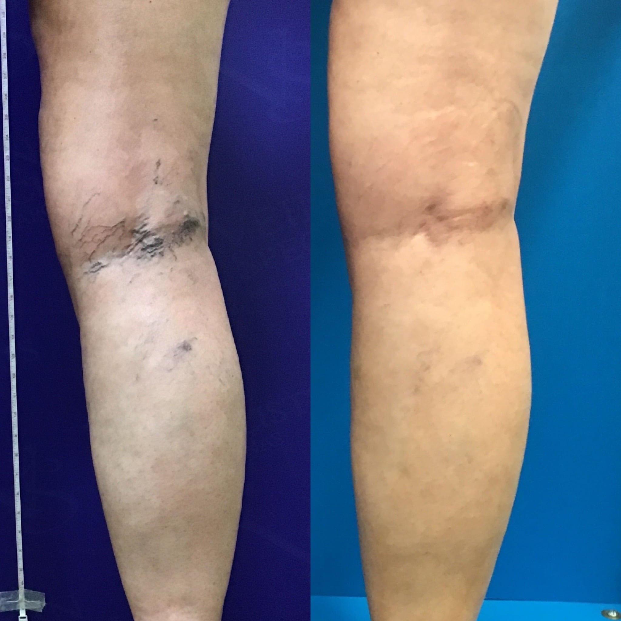 Fall Vein Treatment Is the Perfect Time!