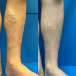 Take Advantage of 10% Off Cosmetic Sclerotherapy During The Month Of May!, Vein Specialists of the Carolinas You Know What Day It Is - Today Is Transformation Tuesday!