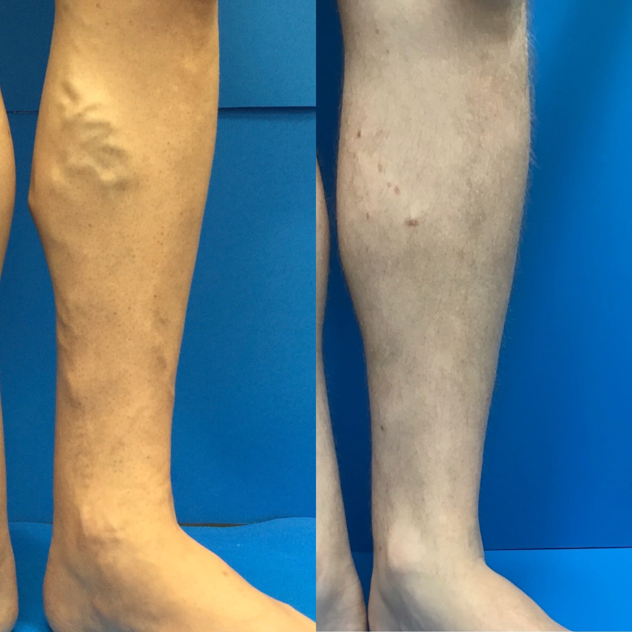 At What Age Do Varicose Veins Appear? - BHVCI - Blog