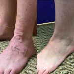 Causes of Spider Veins, Vein Specialists of the Carolinas Today is Transformation Tuesday!