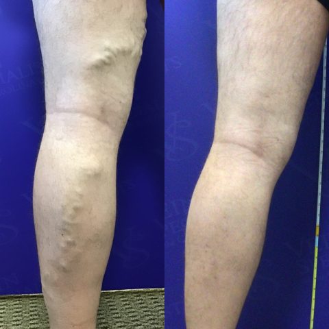 Transformation Tuesday Is Back! - Vein Specialists of the Carolinas