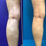 Get Your Blood Pumping in Charlotte For Healthy Veins, Vein Specialists of the Carolinas Another Week Another Transformation Tuesday!