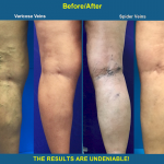 VSC is offering 10% off all Cosmetic Spider Vein Treatments during the month of June!, Vein Specialists of the Carolinas The Before and After Transformation!