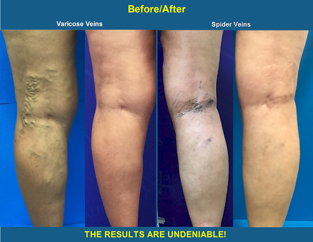 Varicose Veins Treatment Before and Afters