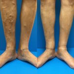 Before and after vein treatment